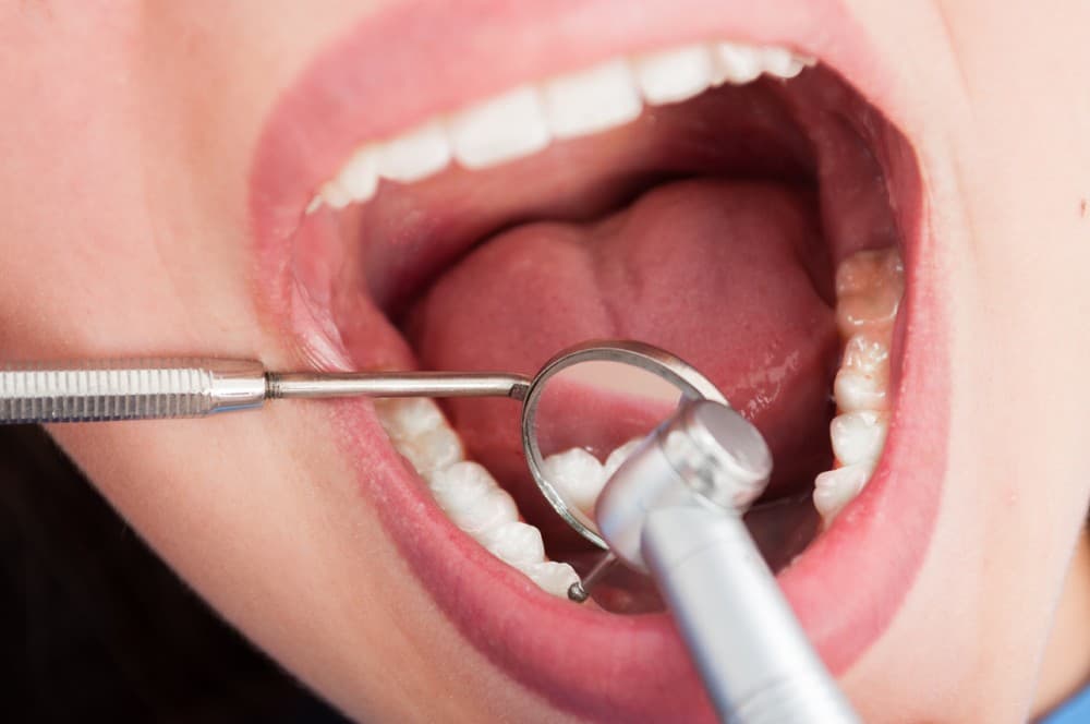 Tratamiento de endodoncia en Ferrol