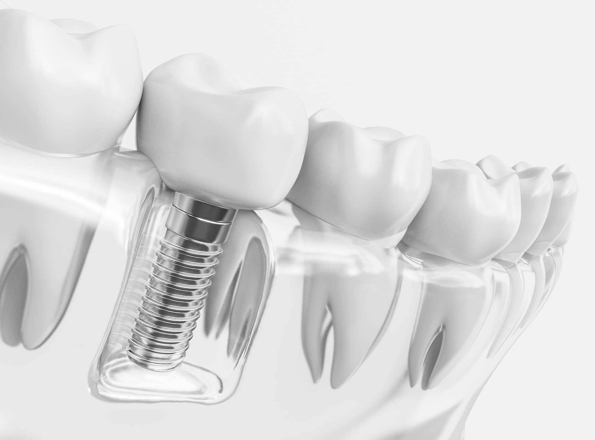 Implantólogo en Ferrol