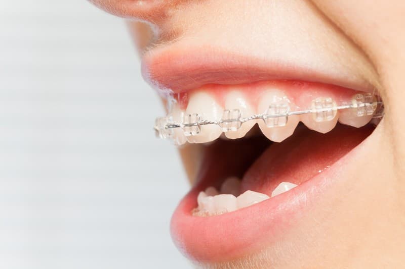 Ortodoncia fija con brackets