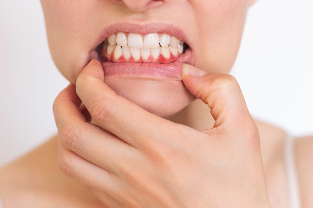 Gingivitis
