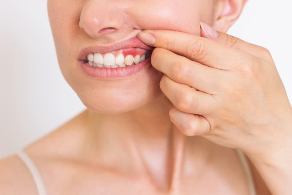 Periodontitis